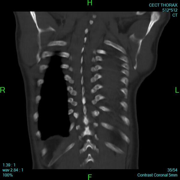File:Bone metastases from lung carcinoma (Radiopaedia 54703-60937 Coronal bone window 35).jpg