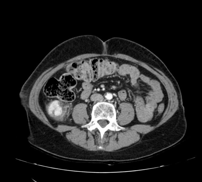File:Bosniak renal cyst - type IV (Radiopaedia 22929-22953 B 64).jpg