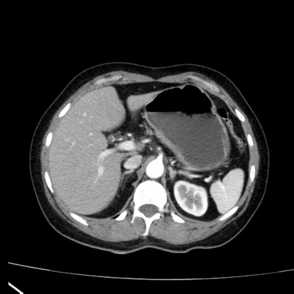 File:Bosniak renal cyst - type I (Radiopaedia 27479-27675 renal cortical phase 19).jpg