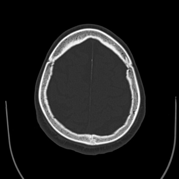 File:Brain Pantopaque remnants (Radiopaedia 78403-91048 Axial bone window 55).jpg