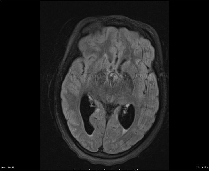 File:Brainstem glioma (Radiopaedia 21819-21775 Axial FLAIR 19).jpg