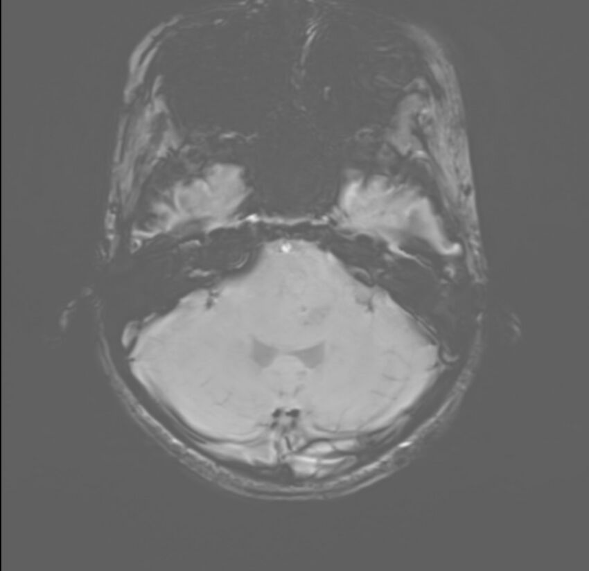 Brainstem glioma (Radiopaedia 70548-80674 Axial SWI 11).jpg