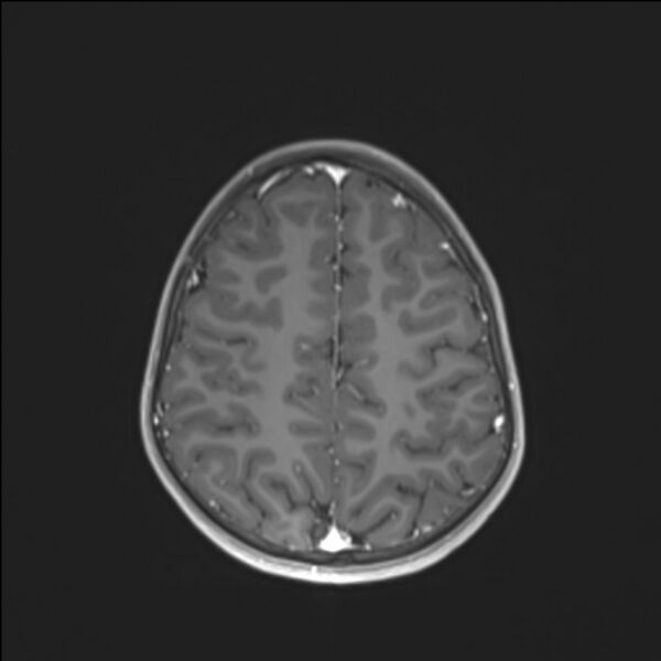 File:Brainstem glioma (Radiopaedia 70548-80674 Axial T1 C+ 119).jpg