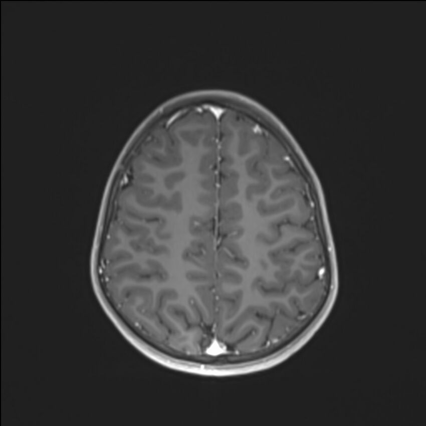 Brainstem glioma (Radiopaedia 70548-80674 Axial T1 C+ 119).jpg