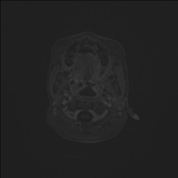 File:Brainstem glioma (Radiopaedia 70548-80674 Axial T1 C+ 4).jpg