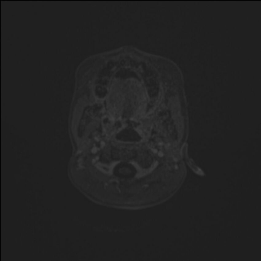 Brainstem glioma (Radiopaedia 70548-80674 Axial T1 C+ 4).jpg
