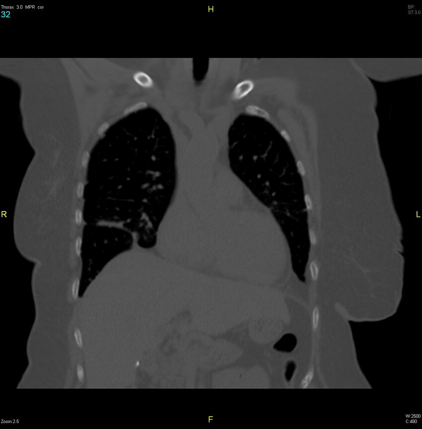 Breast primary with lung and bone metastases (Radiopaedia 40620-43228 bone window 32).jpg