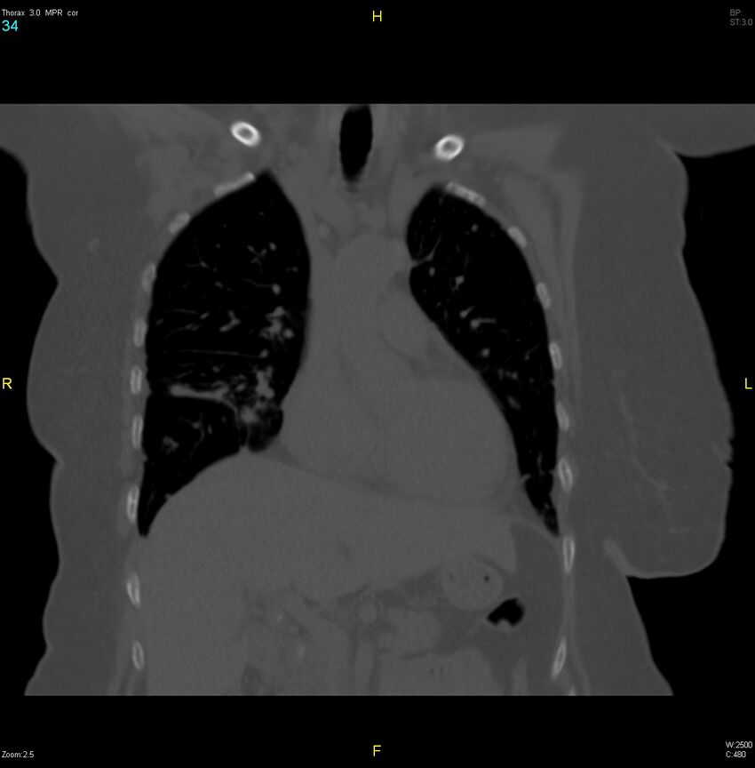 Breast primary with lung and bone metastases (Radiopaedia 40620-43228 bone window 34).jpg
