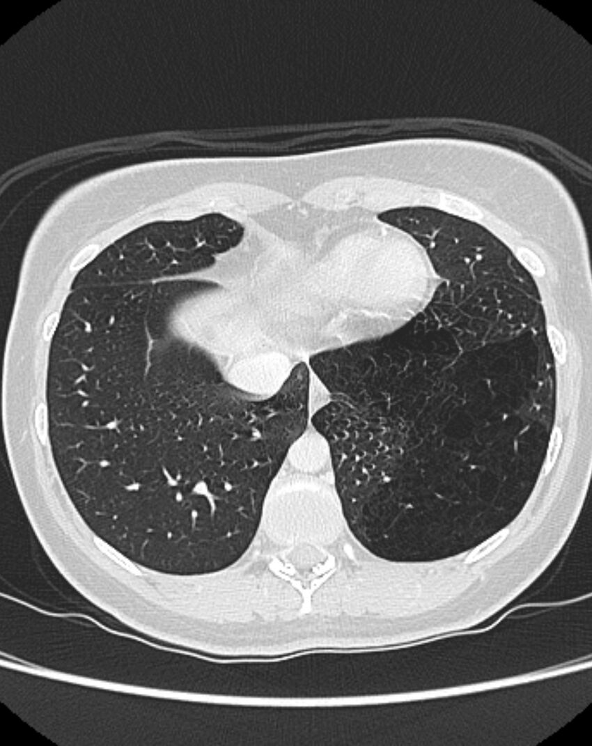 Bronchial atresia (Radiopaedia 50007-55297 Axial lung window 86).jpg