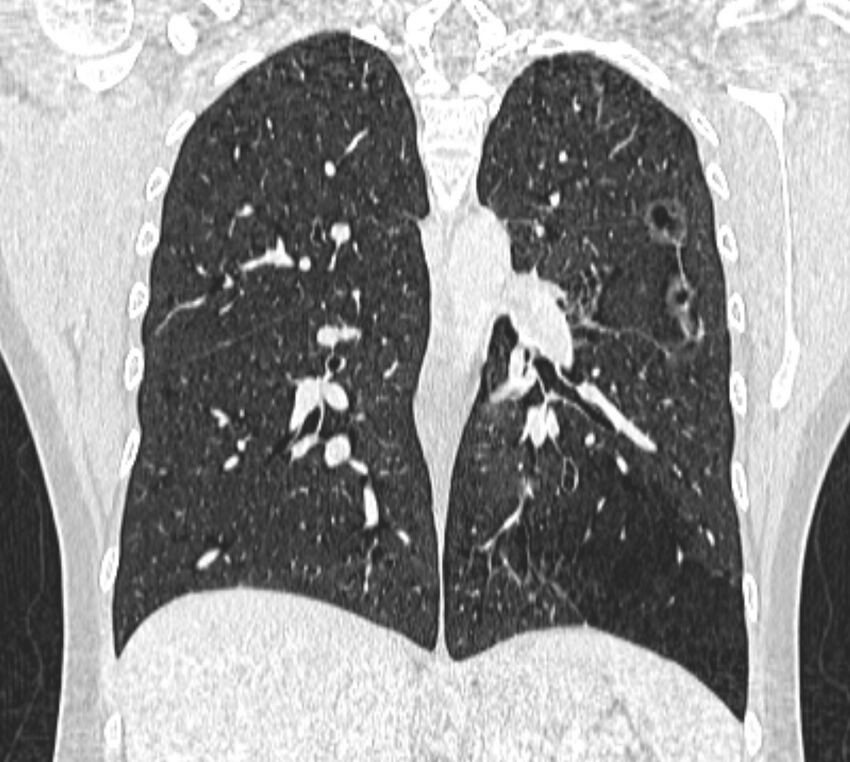 Bronchial atresia (Radiopaedia 50007-55297 Coronal lung window 67).jpg