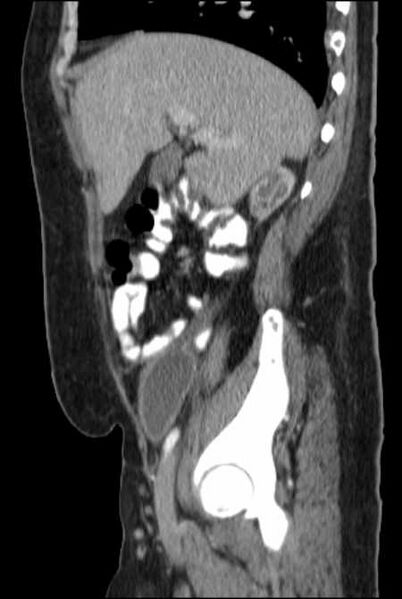 File:Brown tumors compressing the spinal cord (Radiopaedia 68442-77988 F 18).jpg