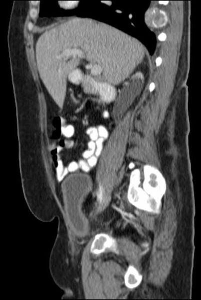 File:Brown tumors compressing the spinal cord (Radiopaedia 68442-77988 F 22).jpg