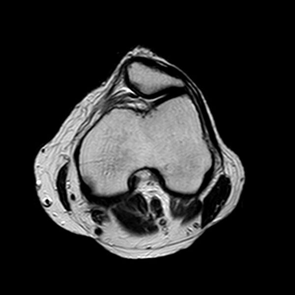 File:Bucket handle tear - medial meniscus (Radiopaedia 29250-29664 Axial T2 12).jpg