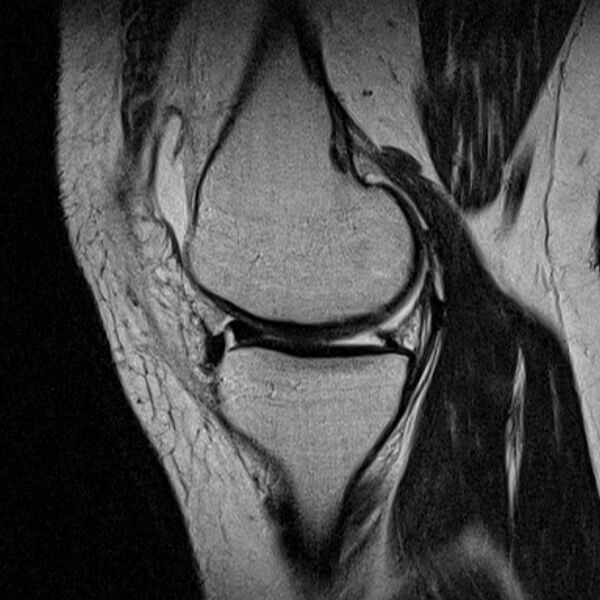 File:Bucket handle tear - medial meniscus (Radiopaedia 79028-91942 Sagittal T2 17).jpg