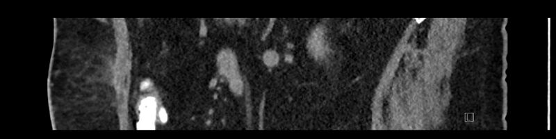 File:Buried bumper syndrome - gastrostomy tube (Radiopaedia 63843-72575 Sagittal Inject 45).jpg