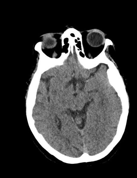 File:Burnt-out meningioma (Radiopaedia 51557-57337 Axial non-contrast 18).jpg