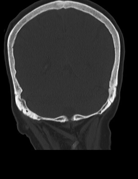 File:Burnt-out meningioma (Radiopaedia 51557-57337 Coronal bone window 41).jpg