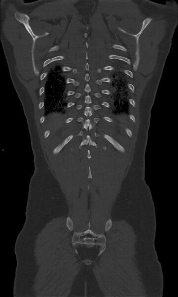 File:Burst fracture (Radiopaedia 83168-97542 Coronal bone window 62).jpg