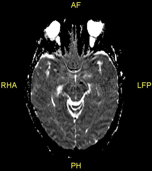 File:Butterfly glioma (Radiopaedia 76707-88526 Axial ADC 11).jpg