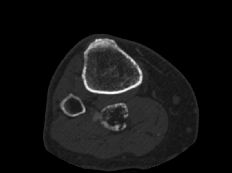 File:Calcified hematoma - popliteal fossa (Radiopaedia 63938-72763 C 86).jpg