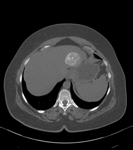 File:Calcified hepatic hydatid cyst (Radiopaedia 81127-94738 Axial non-contrast 16).jpg