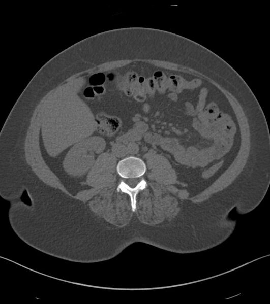 File:Calcified hepatic hydatid cyst (Radiopaedia 81127-94738 Axial non-contrast 54).jpg