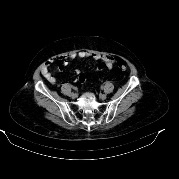 File:Calcified hydatid cyst (Radiopaedia 62000-70085 Axial non-contrast 83).jpg