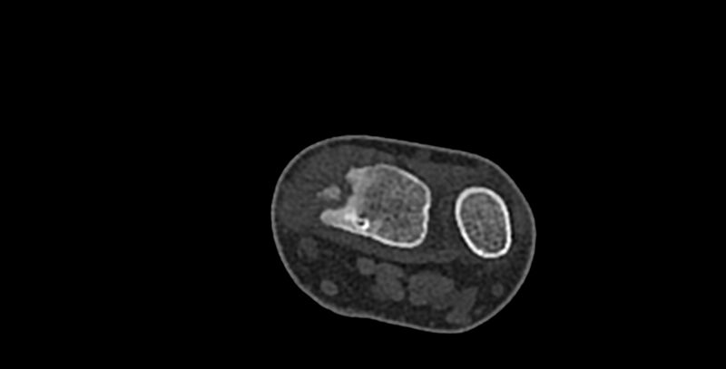 File:Calcifying aponeurotic fibroma (Radiopaedia 88423-105064 Axial bone window 17).jpg