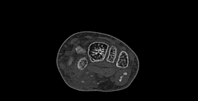 File:Calcifying aponeurotic fibroma (Radiopaedia 88423-105064 Axial bone window 78).jpg