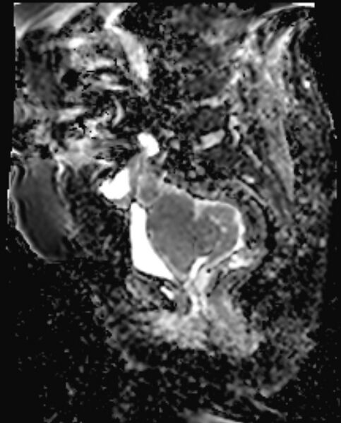 File:Cancer cervix - stage IIb (Radiopaedia 75411-86615 Sagittal ADC 11).jpg