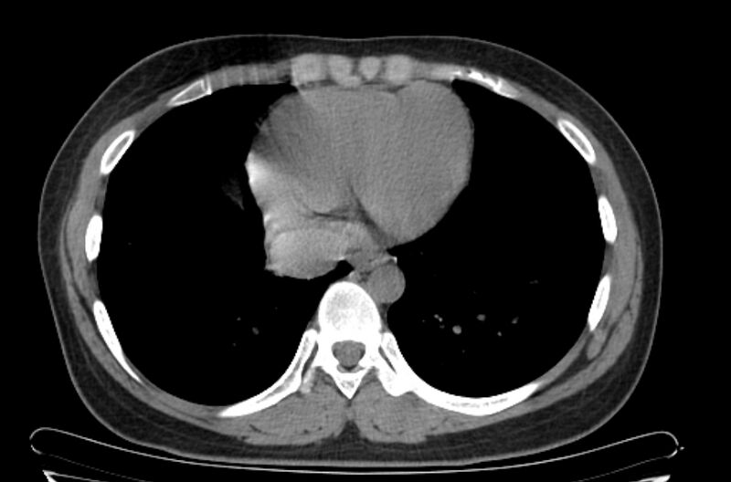 File:Cannonball metastases - uterine choriocarcinoma (Radiopaedia 70137-80173 Axial non-contrast 90).jpg
