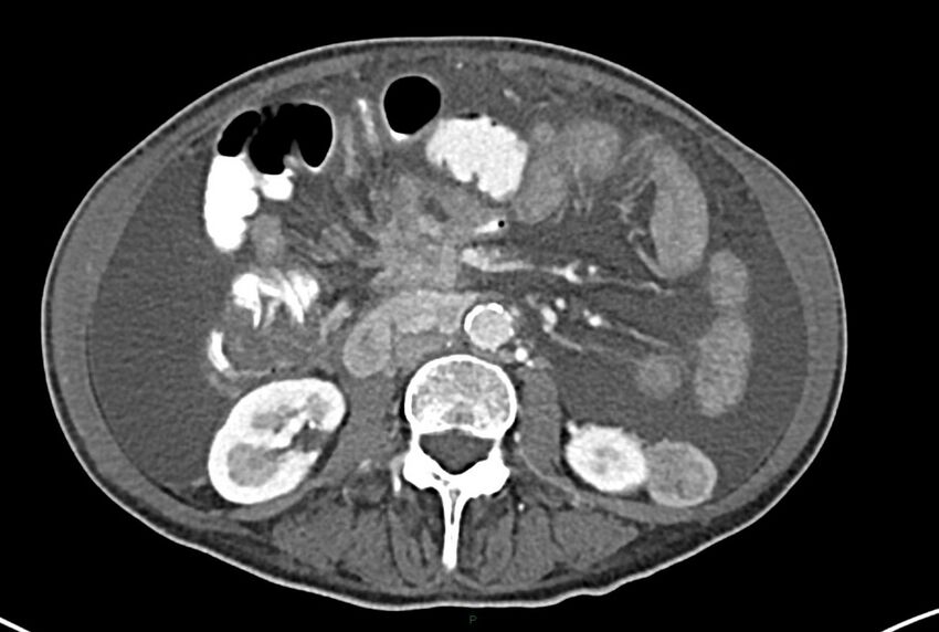 Carcinoid mesenteric tumor complicated by chylous ascites (Radiopaedia 76312-87953 A 37).jpg