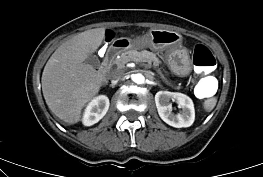 Carcinoid mesenteric tumor complicated by chylous ascites (Radiopaedia 76312-88926 A 24).jpg