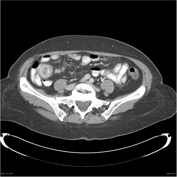 File:Carcinoid tumor of the ileum with metastasis to orbit (Radiopaedia 28165-28425 A 17).jpg
