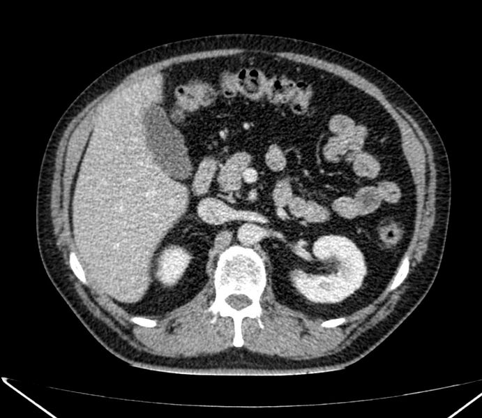 File:Carcinoid tumor with hepatic metastases (Radiopaedia 22651-22670 C 42).jpg