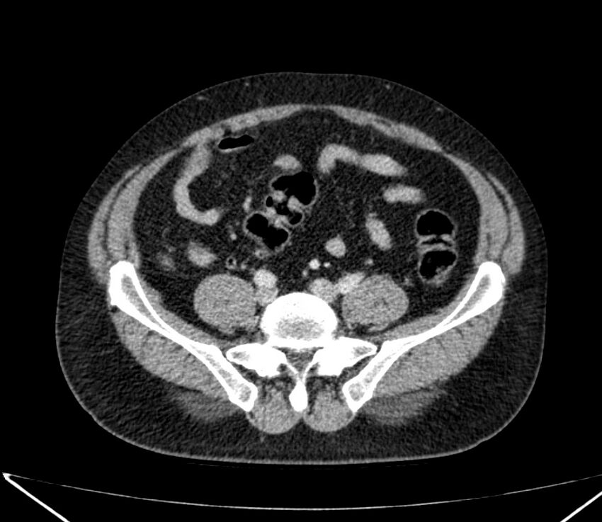 Carcinoid tumor with hepatic metastases (Radiopaedia 22651-22670 C 62).jpg