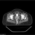 Carcinoma cervix- brachytherapy applicator (Radiopaedia 33135-34173 Axial non-contrast 33).jpg