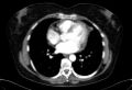 Cardiac sarcoidosis (Radiopaedia 74548-85534 A 53).jpg