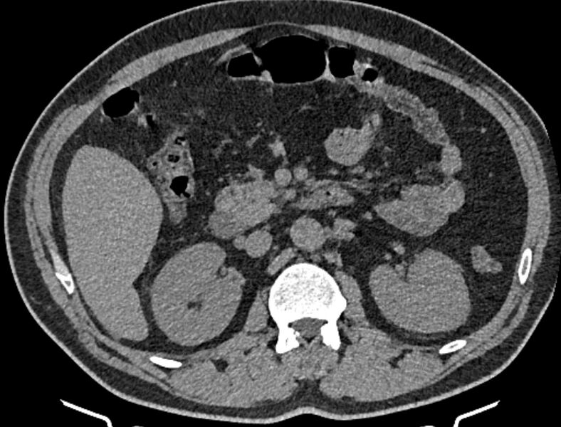 File:Cardiogenic pulmonary edema (Radiopaedia 68180-77678 Axial non-contrast 76).jpg