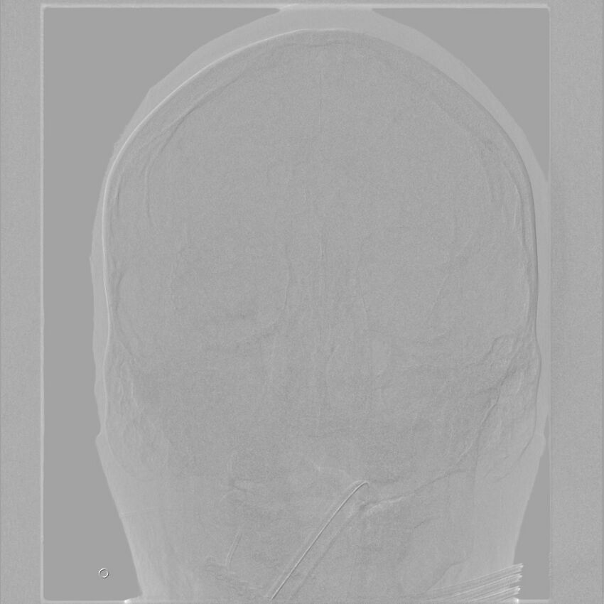 Caroticocavernous fistula - direct (Radiopaedia 61660-69666 A 51).jpg