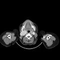 Carotid body tumor (Radiopaedia 21021-20948 A 16).jpg