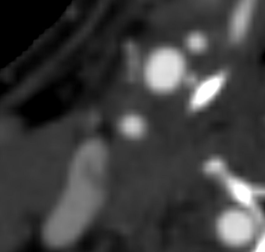 Carotid near-occlusion (Radiopaedia 85304-100887 M 69).jpg