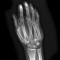 Carpometacarpal fracture dislocation (Radiopaedia 12674-12852 Frontal 1).jpg