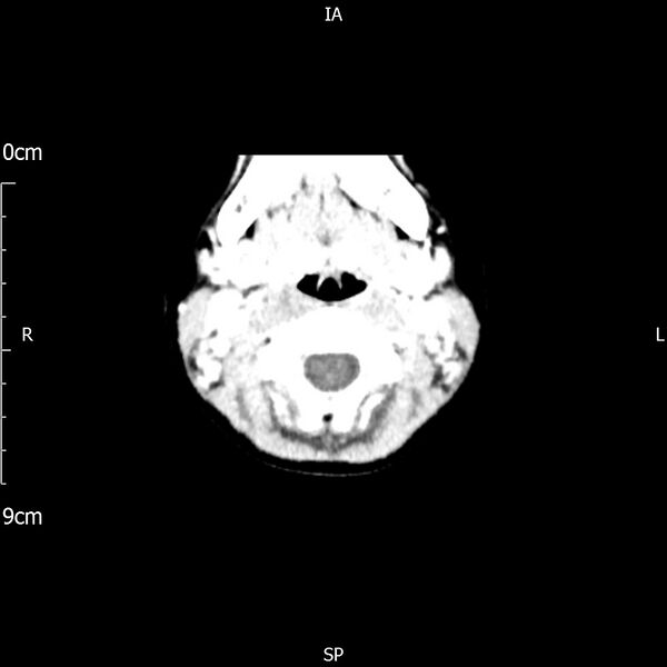 File:Cavernous sinus thrombosis (Radiopaedia 79414-92510 Axial Brain 16).jpg