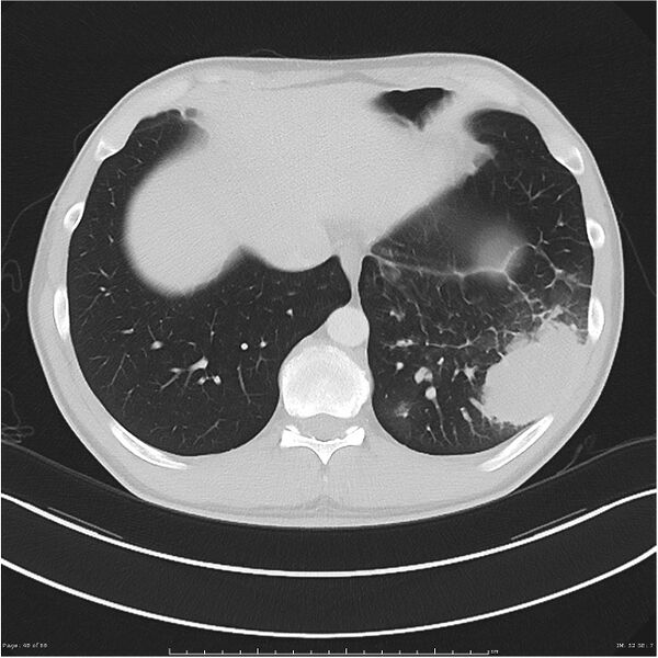 File:Cavitating lung cancer (Radiopaedia 25796-25945 Axial lung window 48).jpg