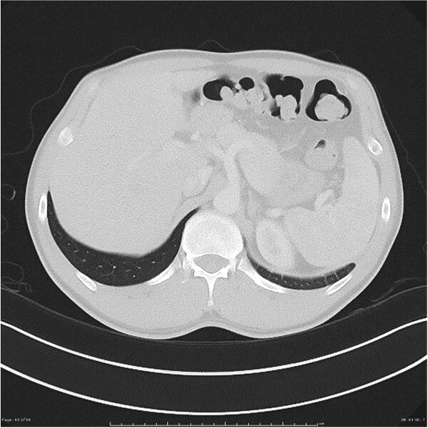 File:Cavitating lung cancer (Radiopaedia 25796-25945 Axial lung window 60).jpg