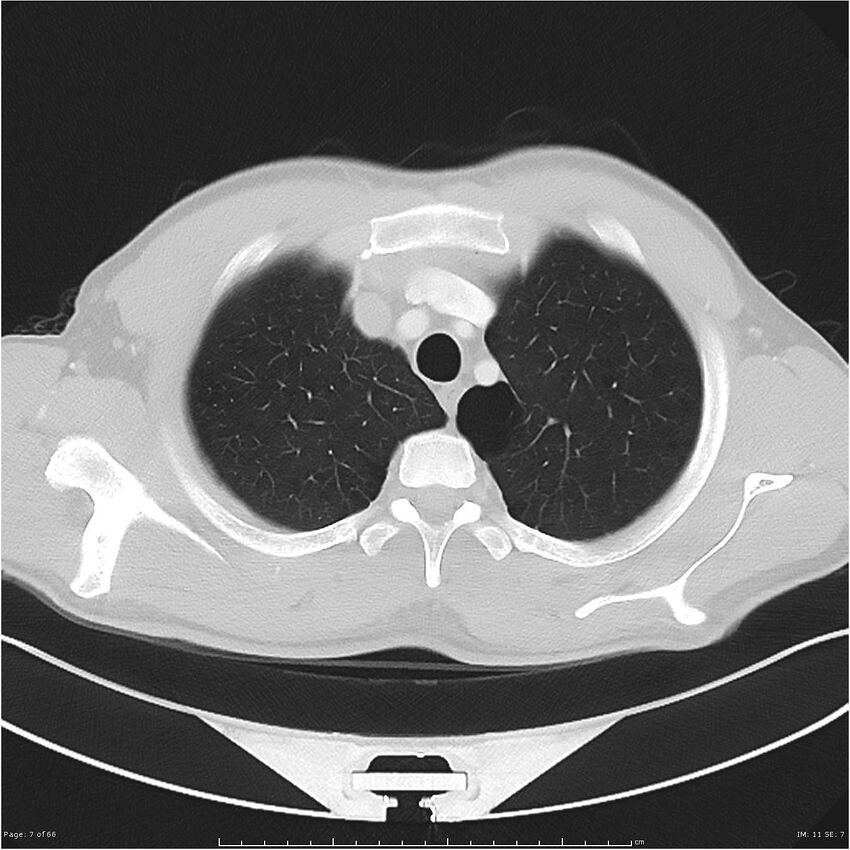 Cavitating lung cancer (Radiopaedia 25796-25945 Axial lung window 7).jpg