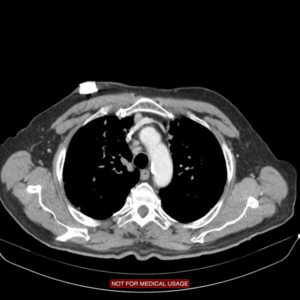 File:Cavitating pulmonary metastases (Radiopaedia 24920-25184 B 5).jpg