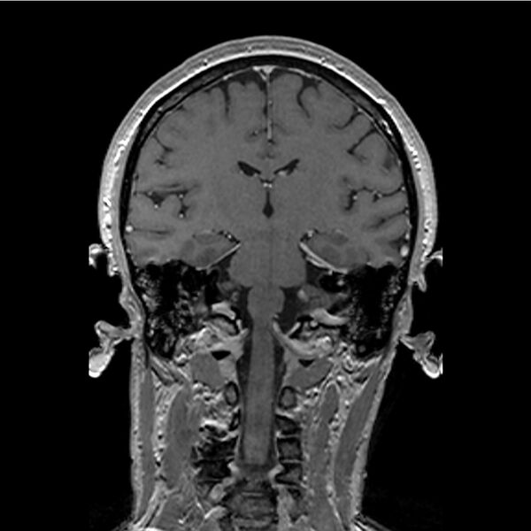 File:Central base of skull meningioma (Radiopaedia 53531-59549 Coronal T1 C+ 29).jpg