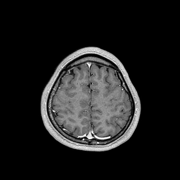 File:Central neurocytoma (Radiopaedia 79320-92380 Axial T1 C+ 194).jpg